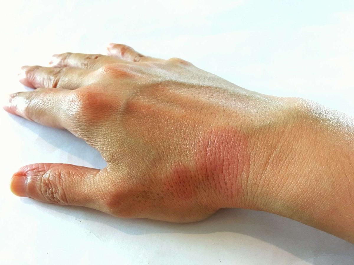 lupus articulaire