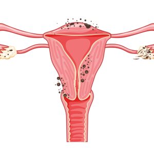 Endometriose en Médecine Chinoise